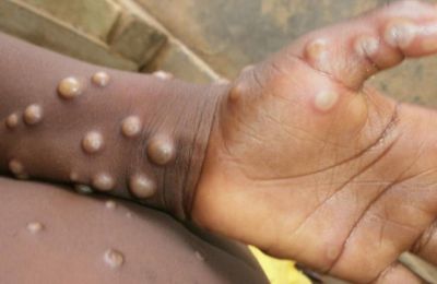 Monkeypox: Dozens of suspected and confirmed cases in Europe and North America