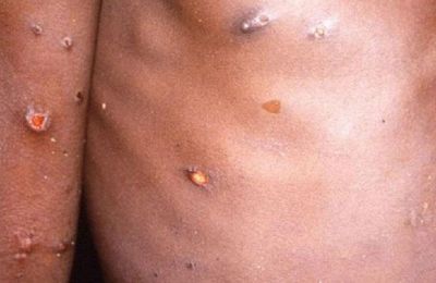 Dr. Kouliou: 'People need to be cautious about monkeypox'