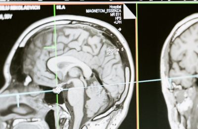 Promising drug slows Alzheimer's decline by 36%