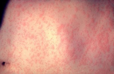 Measles resurgence sparks concern as two unvaccinated cases emerge