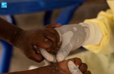 WHO declares Mpox outbreak a global health emergency