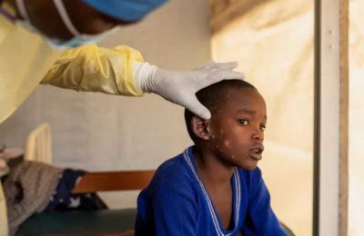 Sweden confirms first case of severe Mpox variant