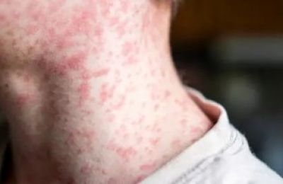 Texas reports first U.S. measles death in a decade as outbreak spreads. Photo credit: Pixabay