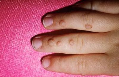 Decision to send home wart-affected students draws scrutiny and divides parents. Photo courtesy of Babycenter.com