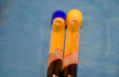 What is plasmapheresis, the treatment in the spotlight after Mazonakis’ death?