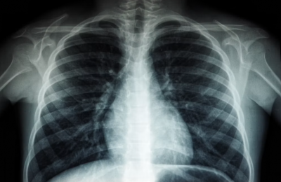 Never smoked? A rare gene may explain why lung cancer still strikes